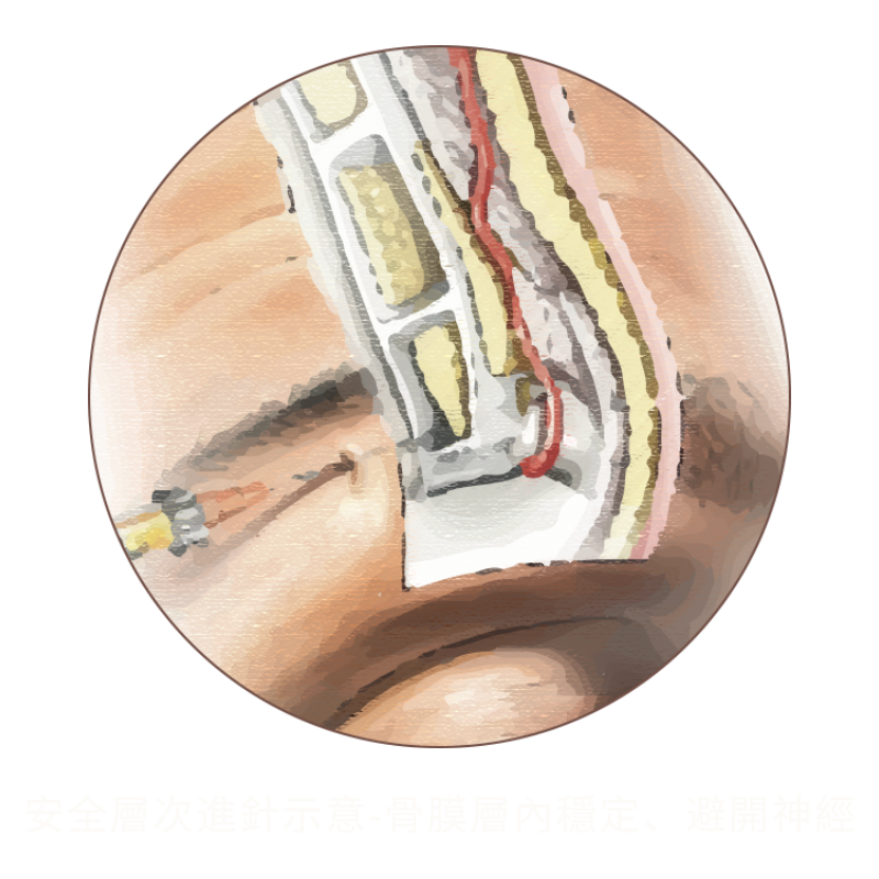 跨層次迴繞拉提｜安全提拉層次與鬆弛來源_安全層次進針示意-骨膜層內穩定、避開神經