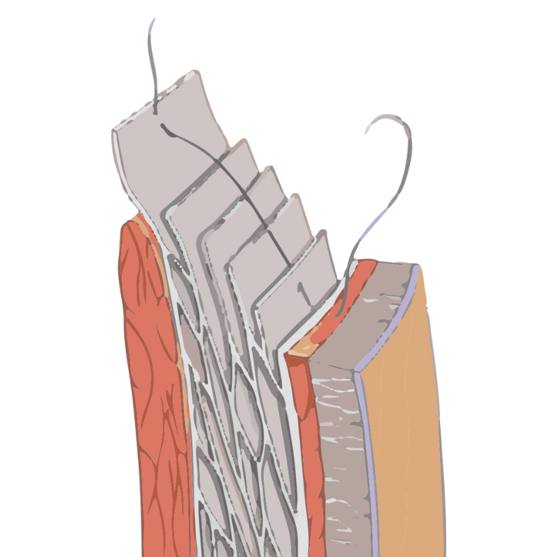 跨層次迴繞拉提｜腔室剝離深入多層脂肪纖維結構
