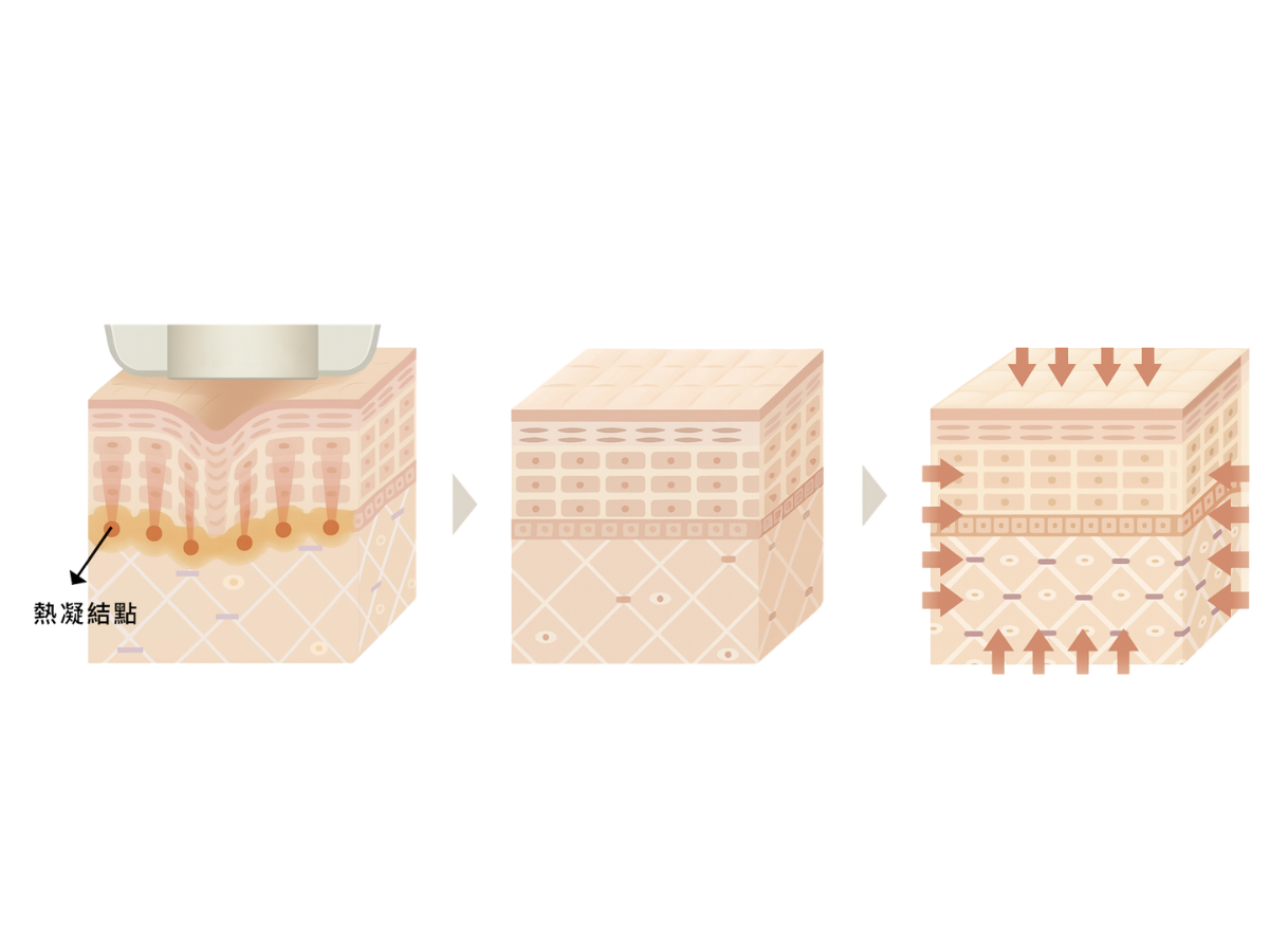 除了當下的緊緻，閃電音波作用在目標層次時，會使組織產生微細、獨立的熱凝結點(TCPs,Thermal Coagulation Points)，還能在療程後一至三個月內啟動膠原蛋白再生重組機制，讓肌膚澎潤飽滿、有彈性。