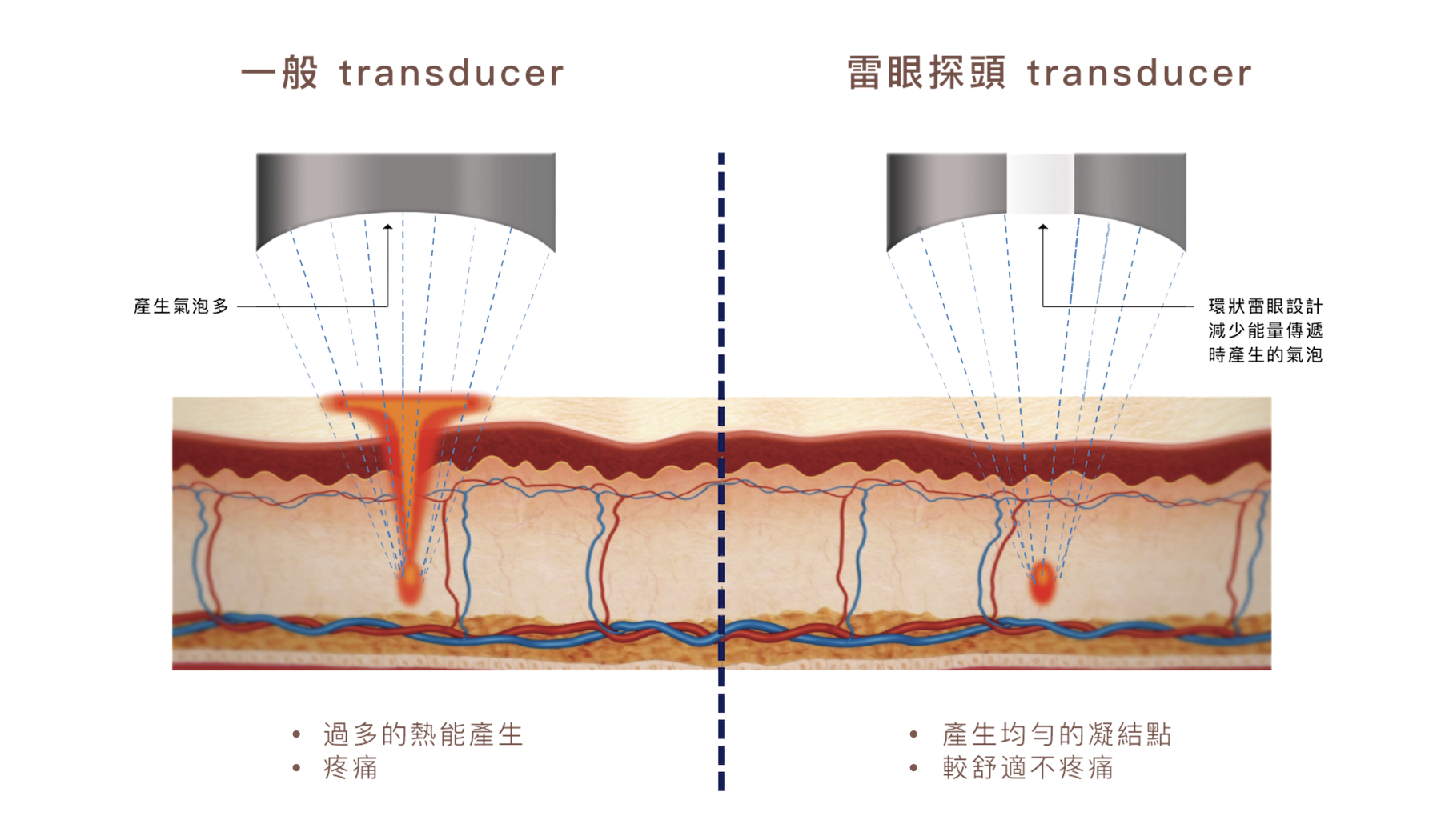 閃電音波搭載的「環狀雷眼探頭」是一項關鍵技術突破。相較於傳統探頭在能量傳導時容易產生大量氣泡，導致能量分布不均、加熱效果不穩定，環狀雷眼設計可有效降低氣泡產生，使超音波能量得以穩定且均勻地傳遞至目標層次。