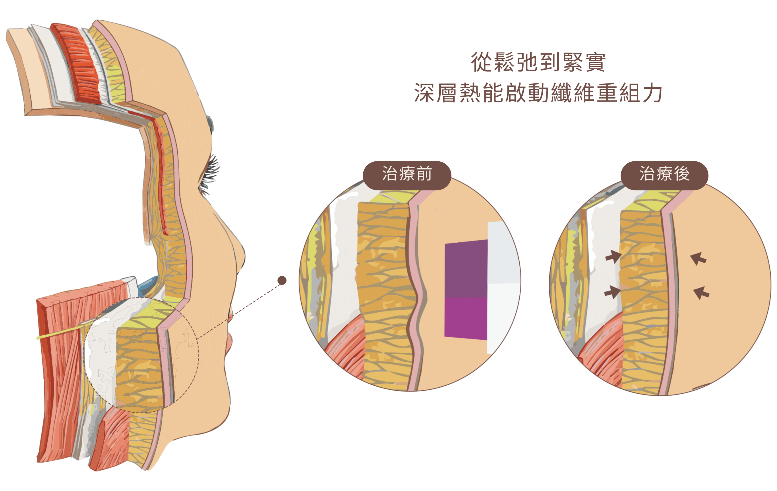 鳳凰電波｜深層熱能啟動纖維重組力