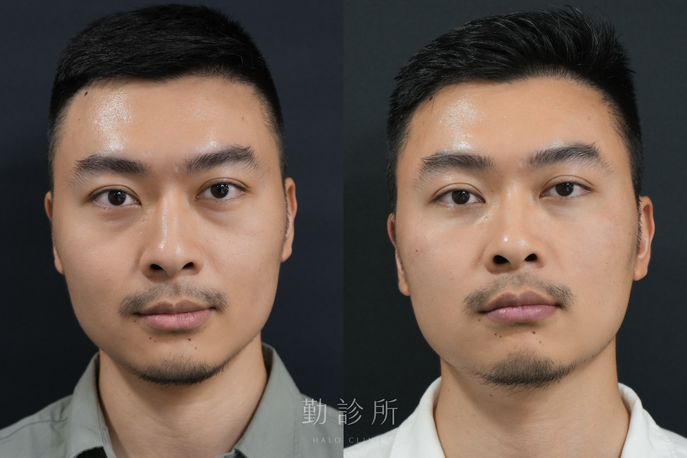 勤診所｜三層式淚溝隱形案例：正面