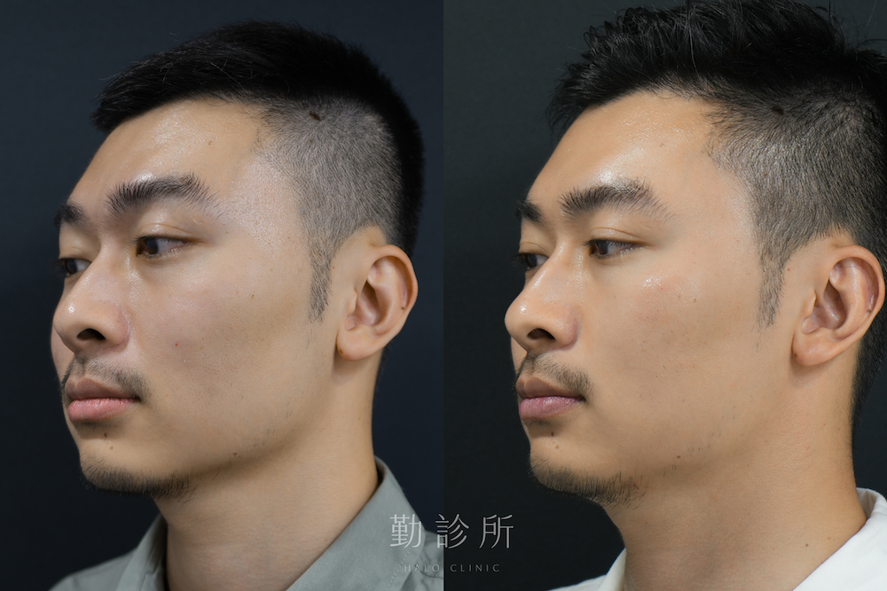 勤診所｜三層式淚溝隱形案例：左臉