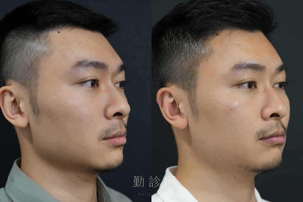 勤診所｜三層式淚溝隱形案例：右臉