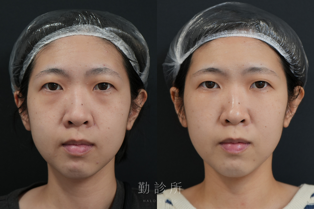 勤診所｜三層式淚溝隱形案例：正面