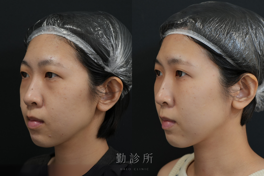 勤診所｜三層式淚溝隱形案例：左臉