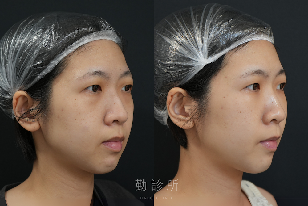 勤診所｜三層式淚溝隱形案例：右臉