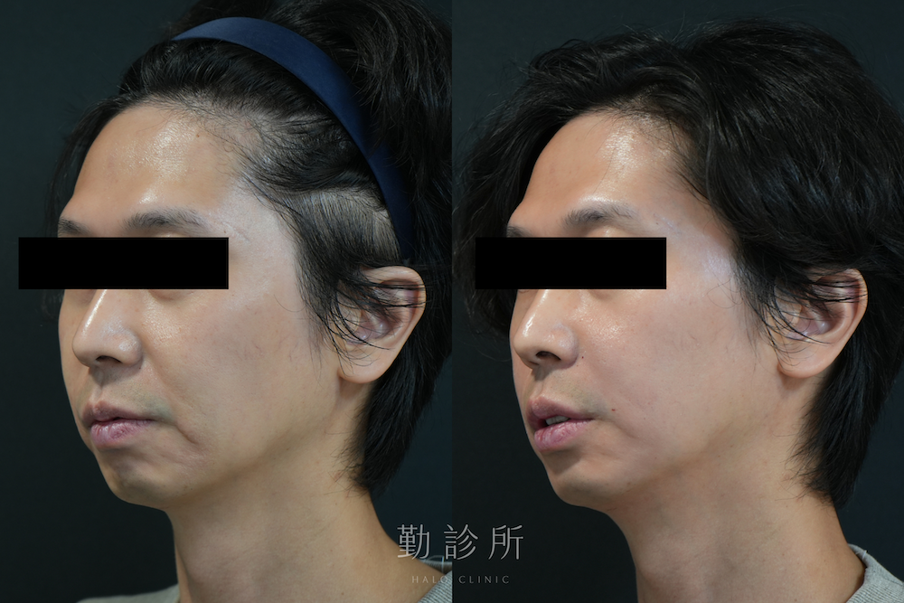 勤診所|法令紋填充案例:緹奧希玻尿酸 左臉