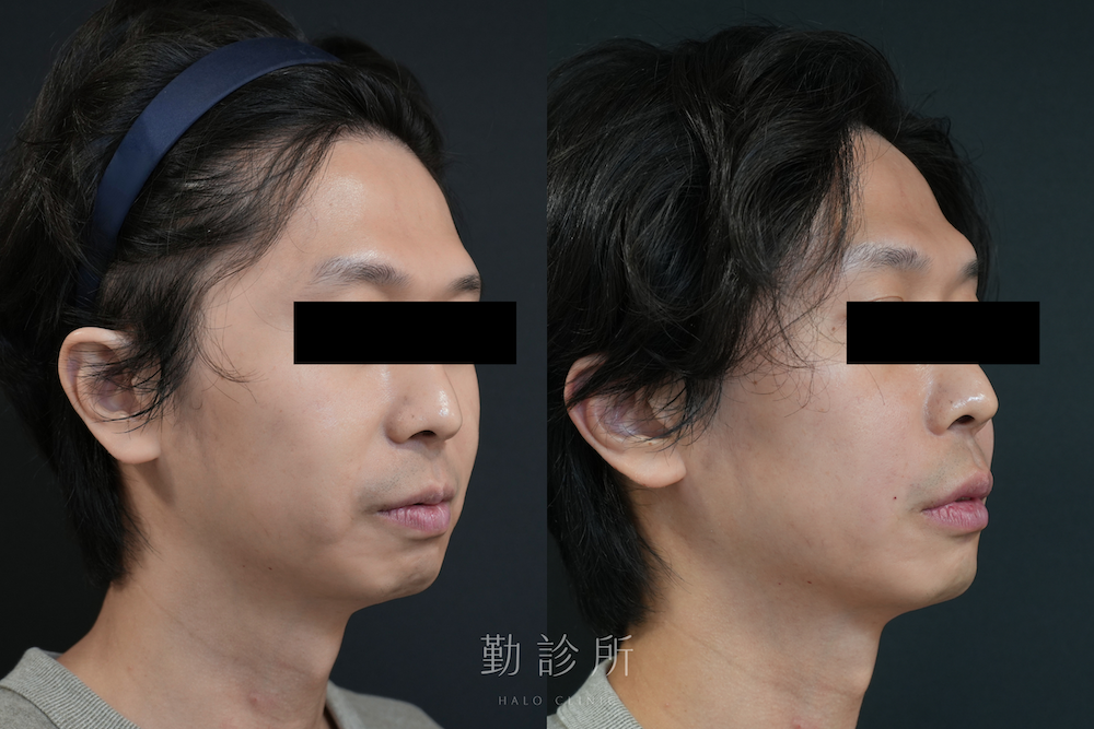 勤診所|法令紋填充案例:緹奧希玻尿酸 右臉