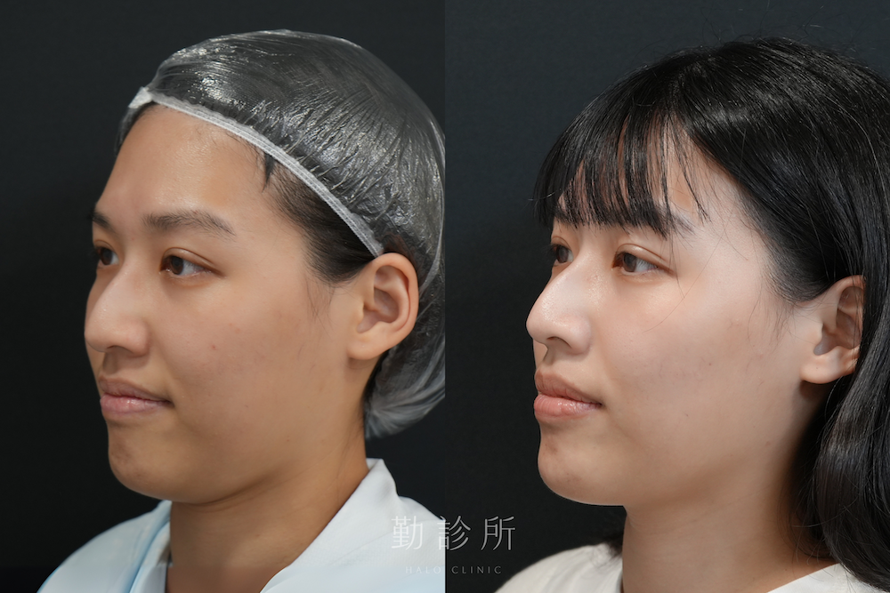 勤診所|舒顏萃 Sculptra 案例:全臉緊緻提升、膚質改善+肉毒輪廓拉提 左臉