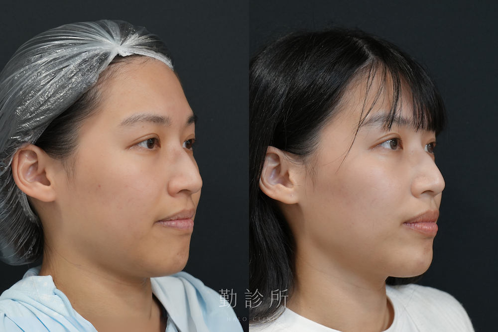 勤診所|舒顏萃 Sculptra 案例:全臉緊緻提升、膚質改善+肉毒輪廓拉提 右臉