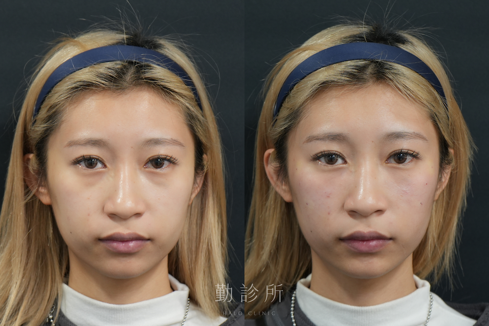 勤診所｜三層式淚溝隱形案例：正面