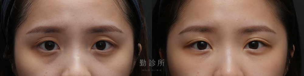 勤診所｜三層式淚溝隱形： 正面