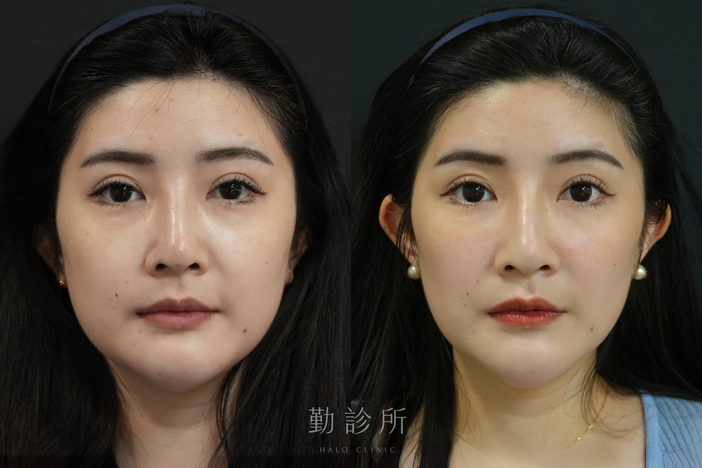 勤診所｜三層式淚溝隱形案例：正面