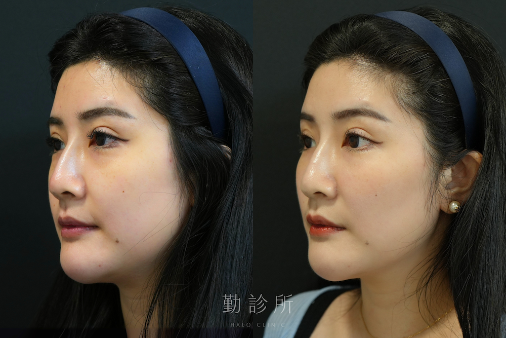 勤診所｜三層式淚溝隱形案例：左臉