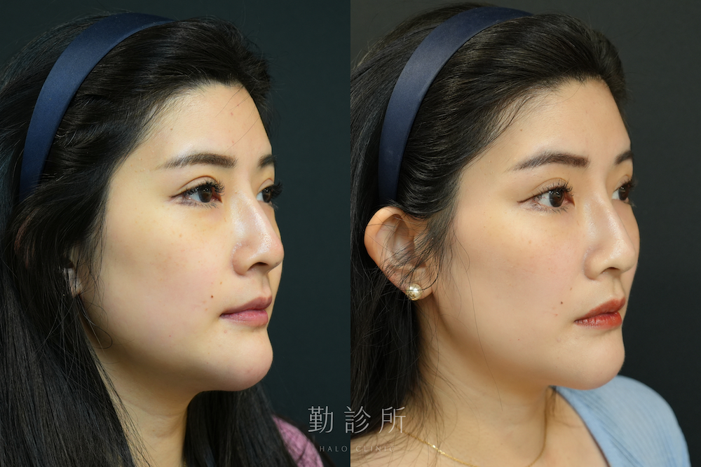 勤診所｜三層式淚溝隱形案例：右臉