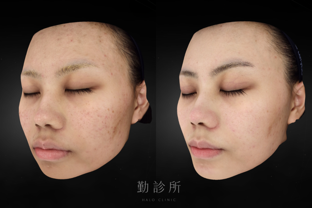 勤診所｜裸光肌雙雷射案例：三次治療後 左臉
