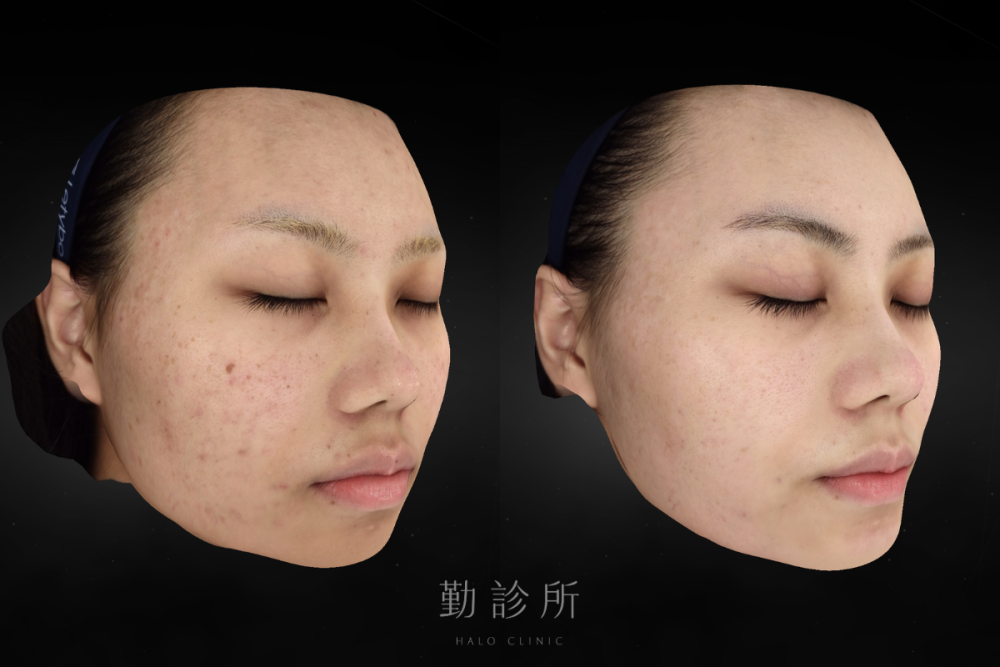 勤診所｜裸光肌雙雷射案例：三次治療後 右臉