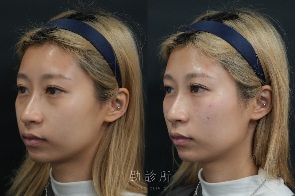 勤診所｜三層式淚溝隱形案例：左臉