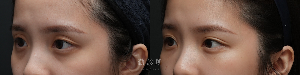 勤診所｜三層式淚溝隱形： 左臉