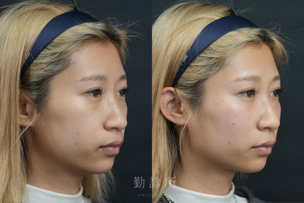 勤診所｜三層式淚溝隱形案例：右臉