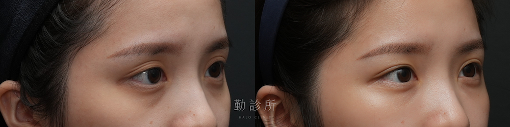 勤診所｜三層式淚溝隱形： 右臉