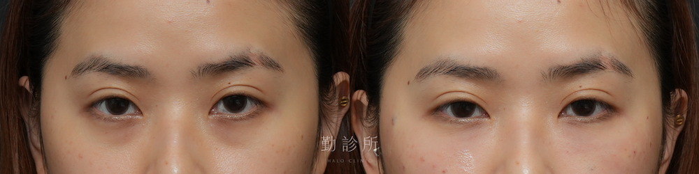 勤診所｜三層式淚溝隱形案例：正面