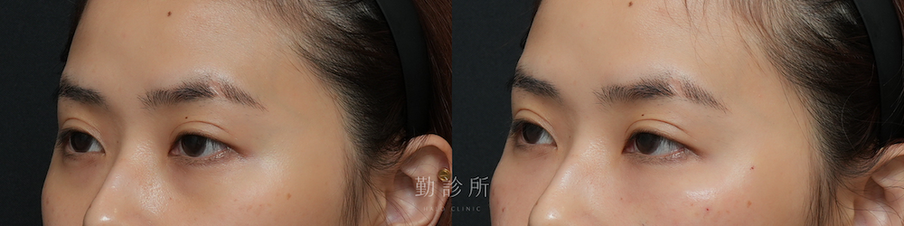 勤診所｜三層式淚溝隱形案例：左臉