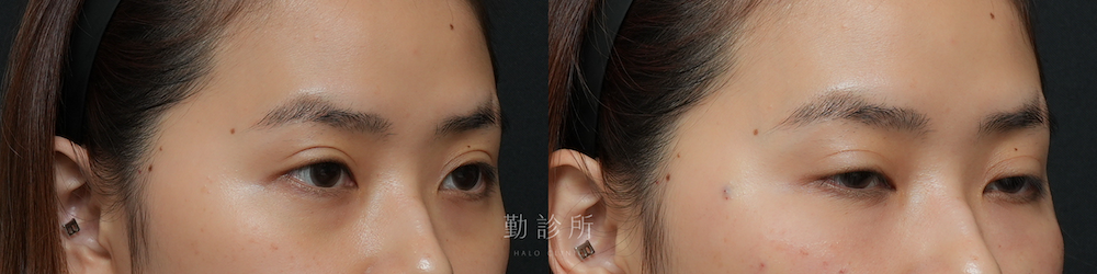 勤診所｜三層式淚溝隱形案例：右臉