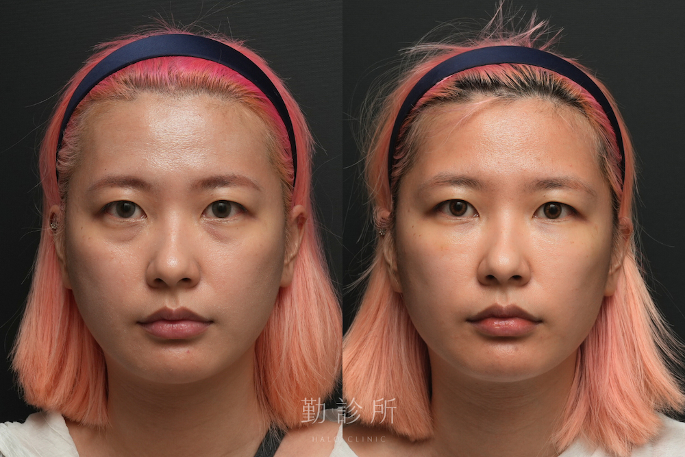 勤診所｜三層式淚溝隱形案例：正面