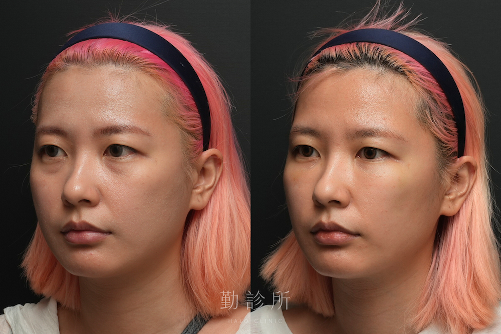 勤診所｜三層式淚溝隱形案例：左臉