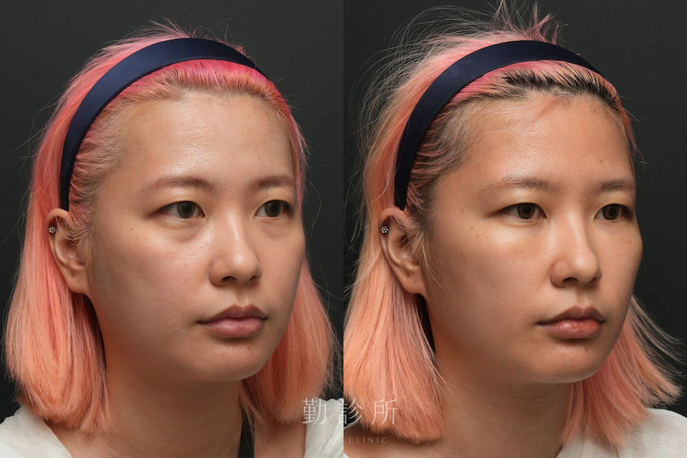 勤診所｜三層式淚溝隱形案例：右臉