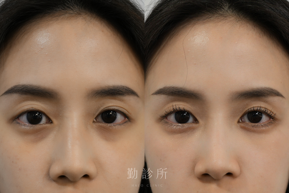 勤診所｜三層式淚溝隱形案例：三層式淚溝隱形＋緹奧希玻尿酸臥蠶填充 正面