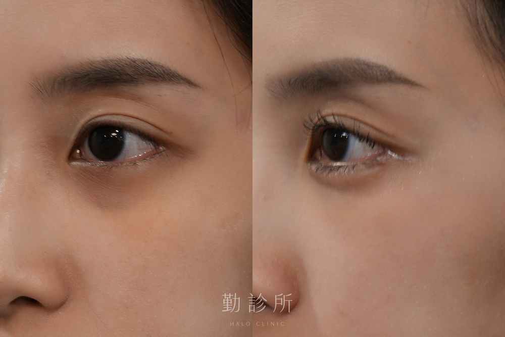 勤診所｜三層式淚溝隱形案例：三層式淚溝隱形＋緹奧希玻尿酸臥蠶填充 左臉
