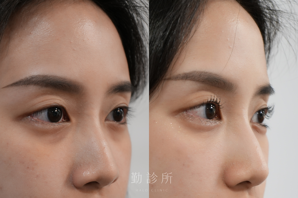 勤診所｜三層式淚溝隱形案例：三層式淚溝隱形＋緹奧希玻尿酸臥蠶填充 右臉