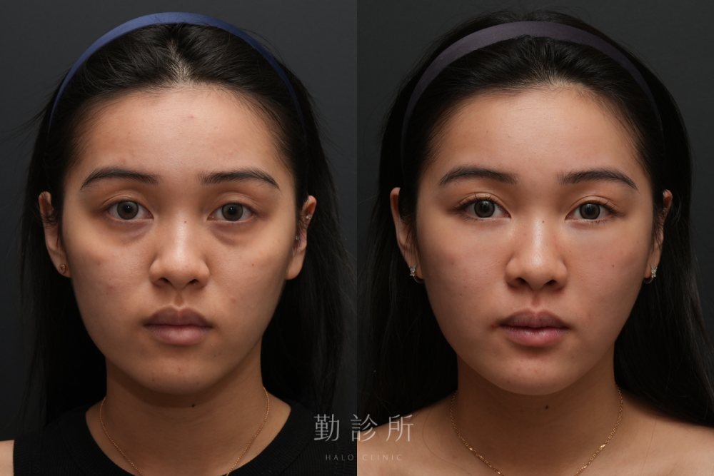 勤診所｜三層式淚溝隱形＋舒顏萃外輪廓： 正面