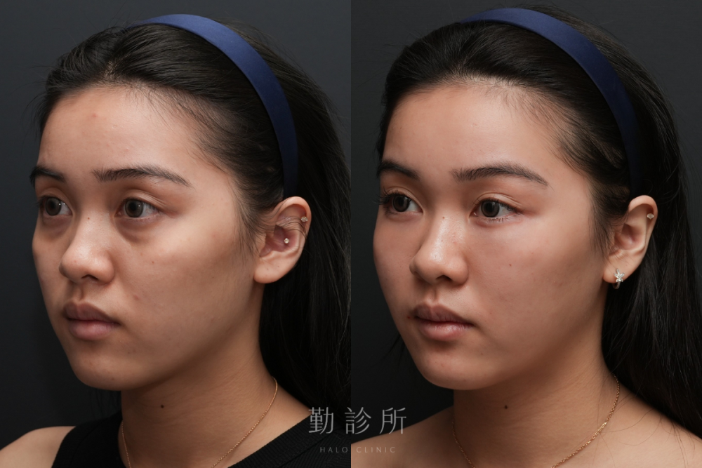 勤診所｜三層式淚溝隱形＋舒顏萃外輪廓： 左臉