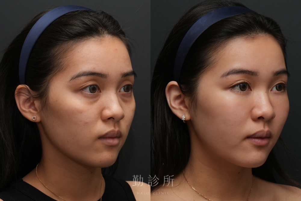勤診所｜三層式淚溝隱形＋舒顏萃外輪廓： 右臉