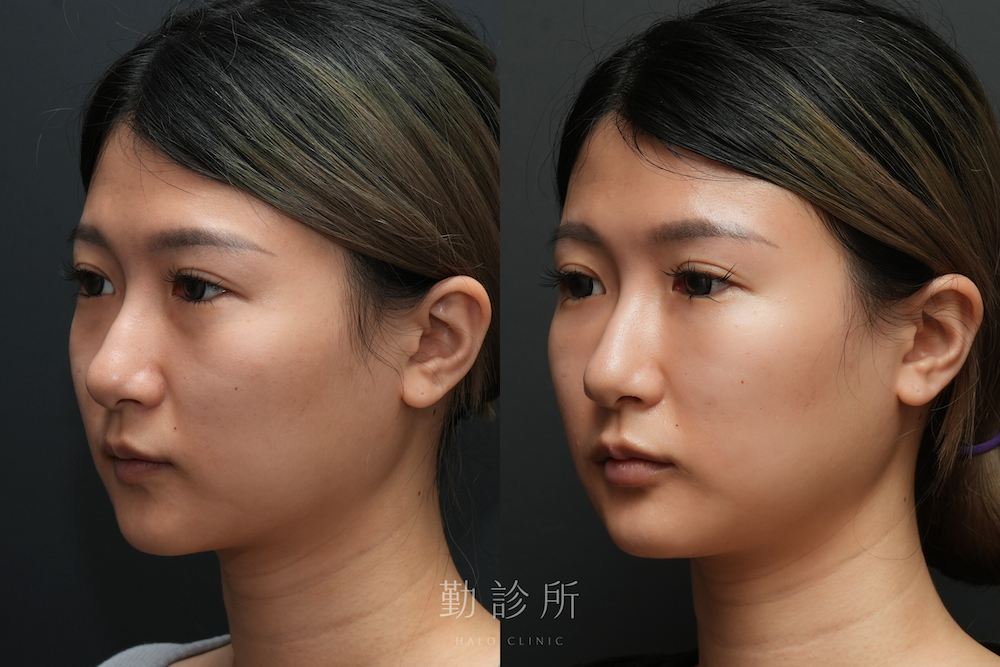 勤診所｜三層式淚溝隱形 + 玻尿酸豐唇 案例：左臉