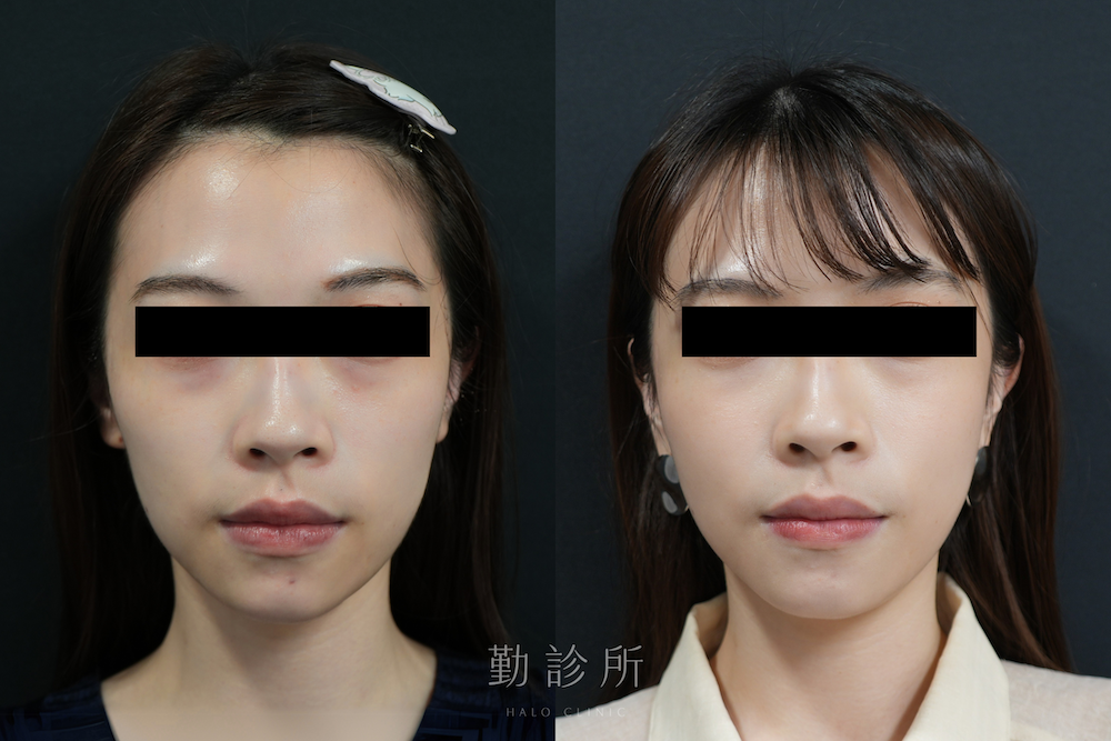 勤診所|舒顏萃 Sculptra 案例:改善頰凹、牙套臉 正面