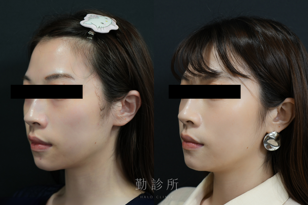 勤診所|舒顏萃 Sculptra 案例:改善頰凹、牙套臉 左臉