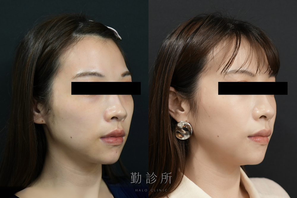 勤診所|舒顏萃 Sculptra 案例:改善頰凹、牙套臉 右臉
