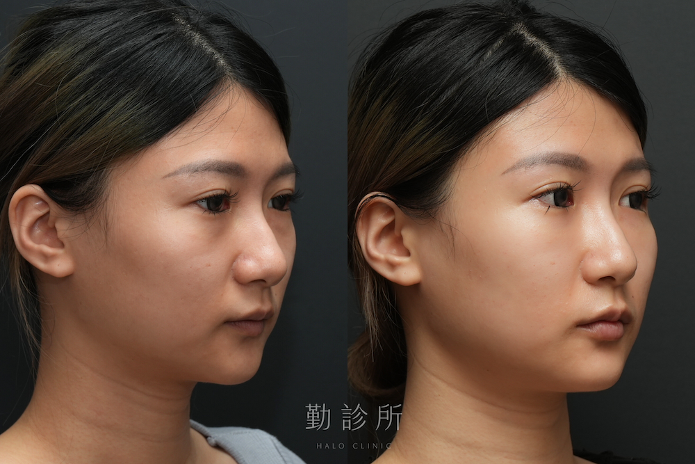 勤診所｜三層式淚溝隱形 + 玻尿酸豐唇 案例：右臉