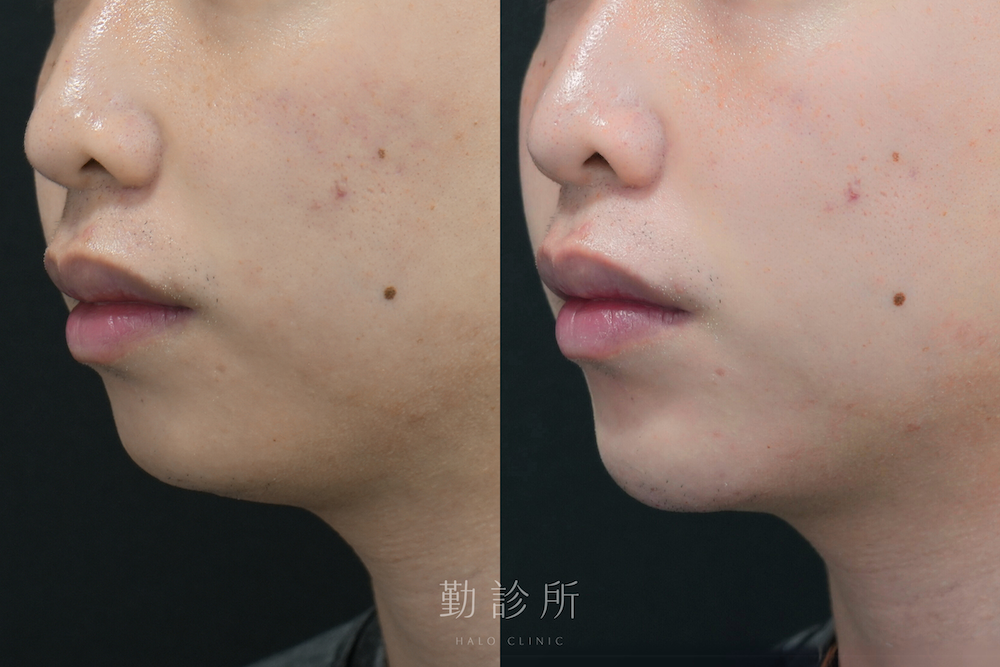 勤診所｜維法熙施打實際案例：左臉