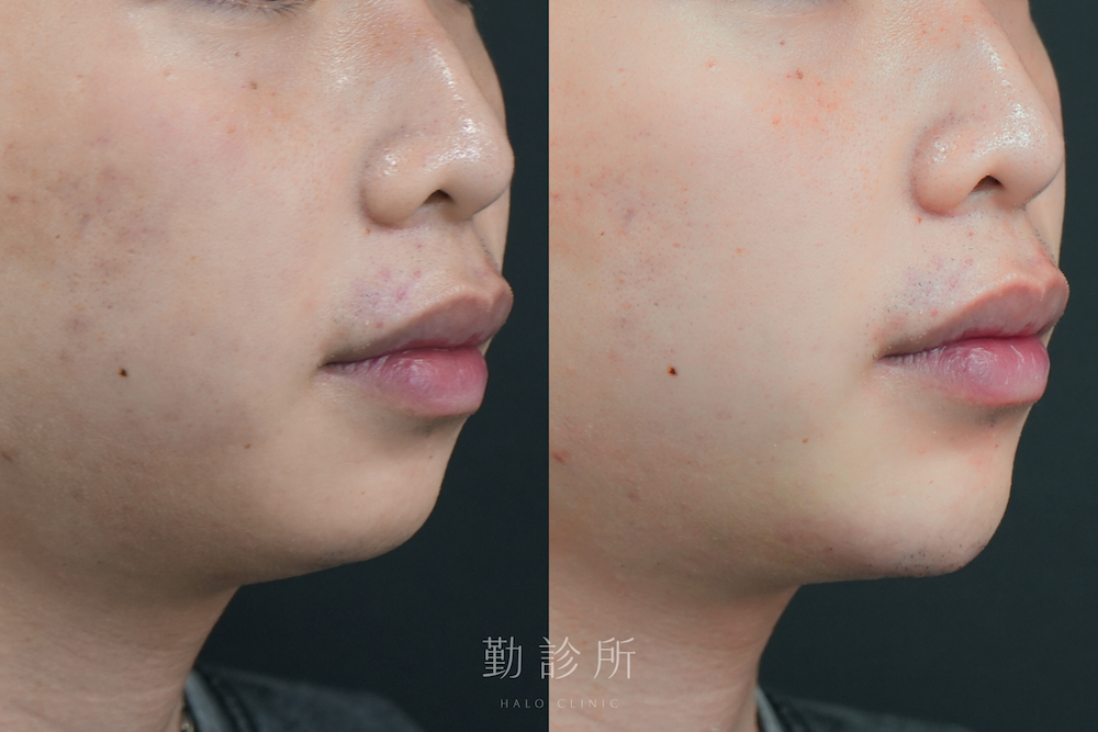 勤診所｜維法熙施打實際案例：右臉
