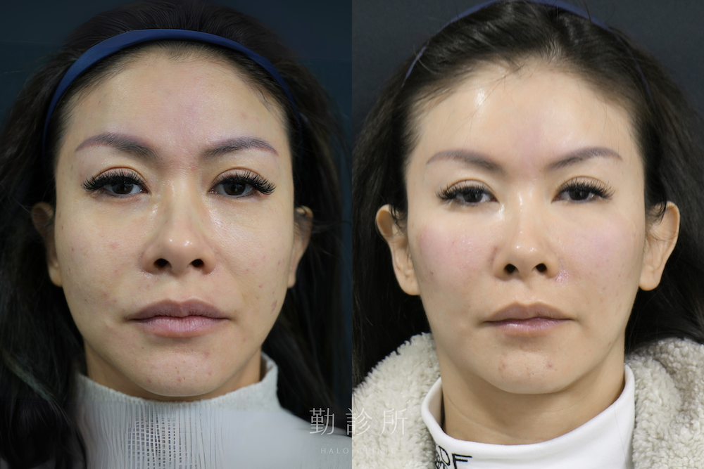 勤診所|法令紋填充案例:仙女玻尿酸 正面