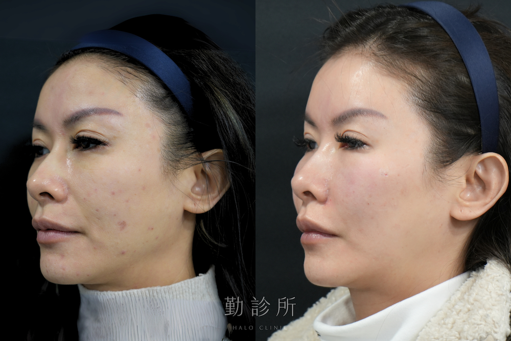 勤診所|法令紋填充案例:仙女玻尿酸 左臉