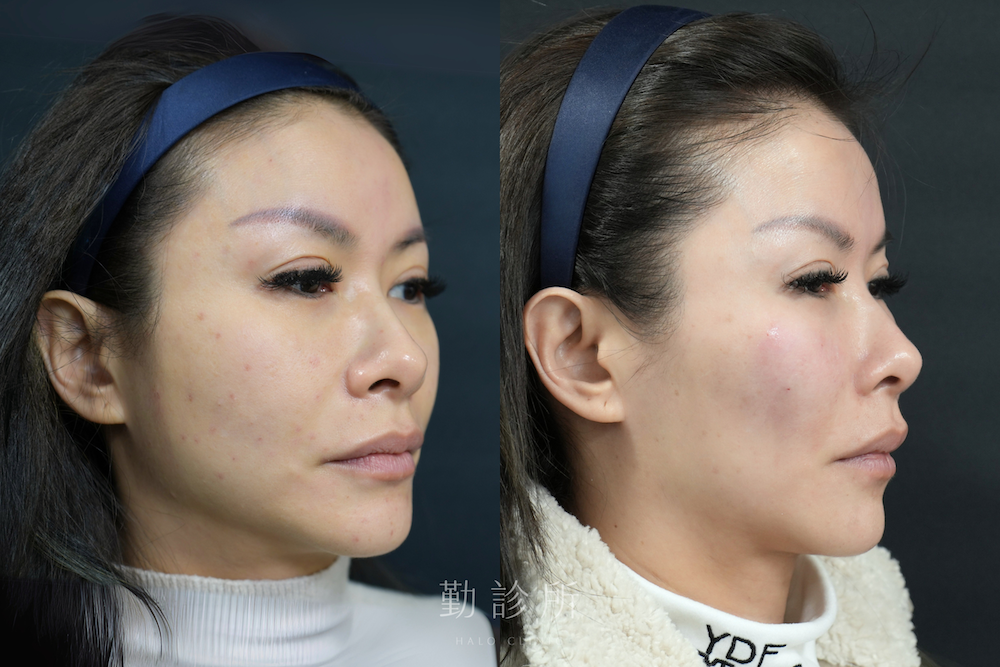 勤診所|法令紋填充案例:仙女玻尿酸 右臉