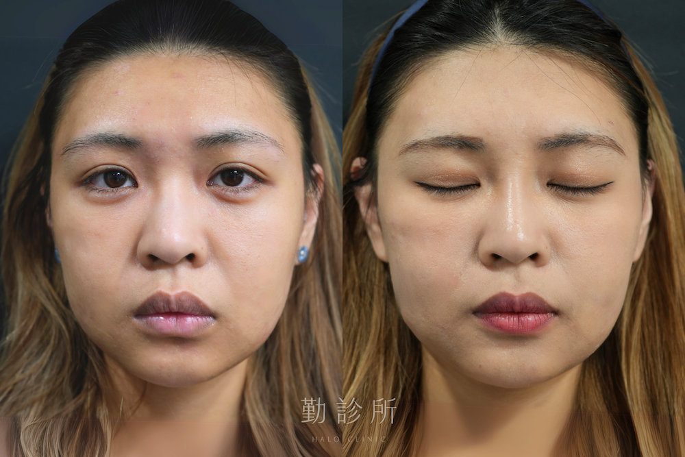 勤診所｜結構式鼻雕案例：正面