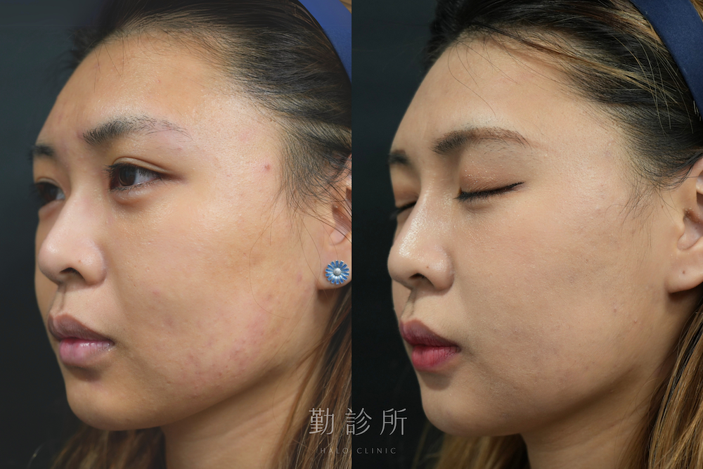 勤診所｜結構式鼻雕案例：左臉